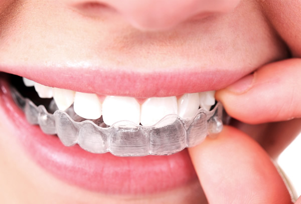 Types Of Teeth Aligners 