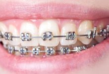 Transform the Indecent Smiles with Dental Braces