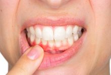 Gum Disease