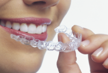 Clear Aligners