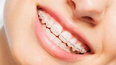 Types Of Teeth Aligners