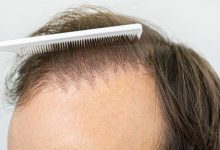 Hair Transplant