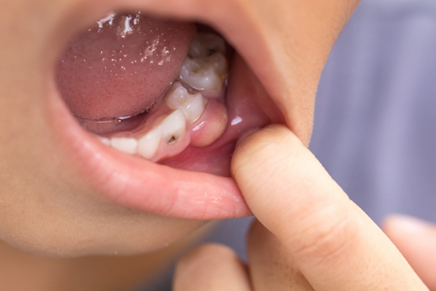 Healthy Foods Can Also Cause Dental Cavities.