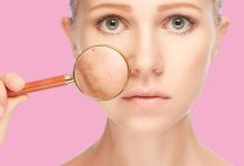 Pigmentation Removal Clinic